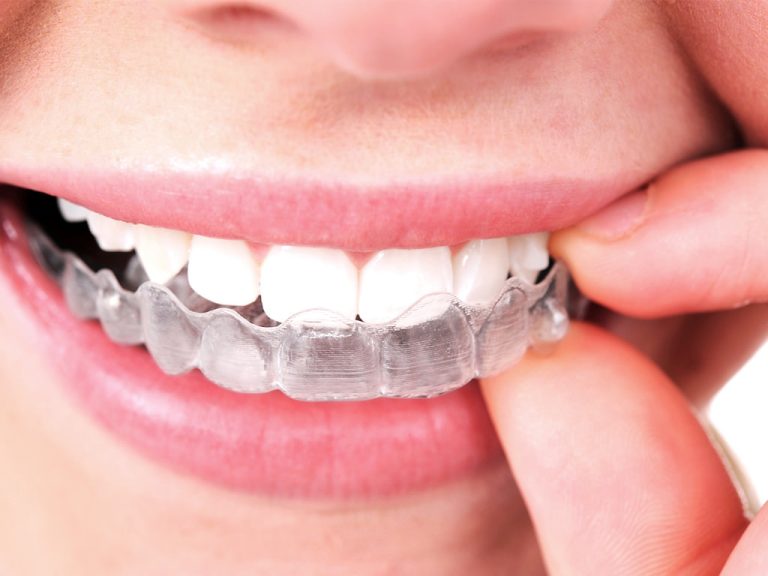How long does it take to see results from Invisalign?  